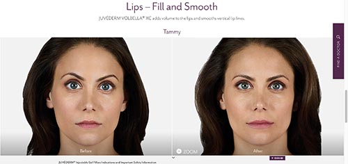 photo d'une femme s'appelant Tammy avant et après l'injection de botox et juvederm