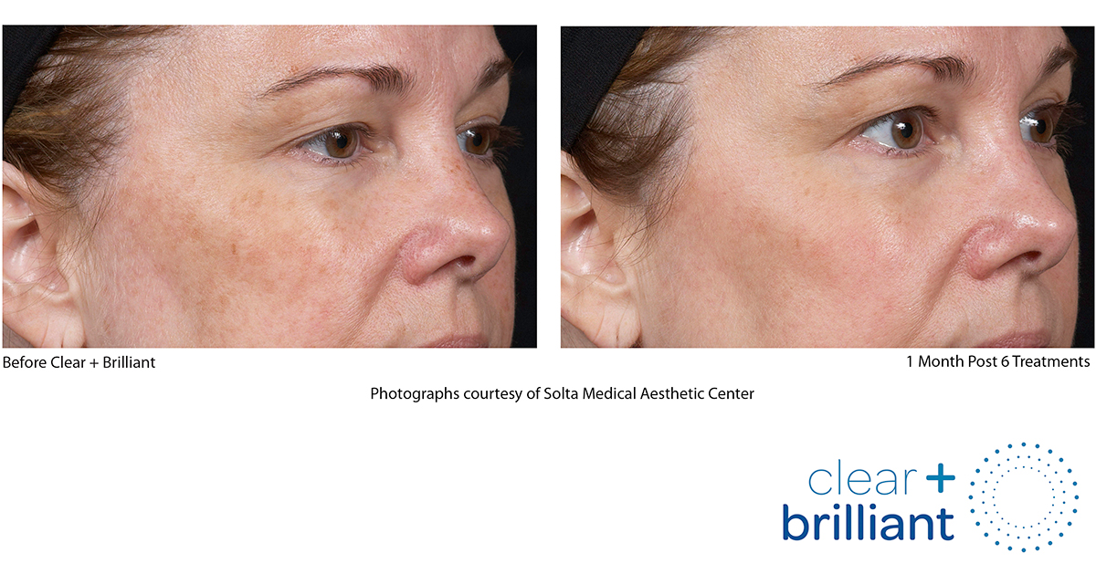 Photo before / after clear + brillant permea laser treatment in Montreal