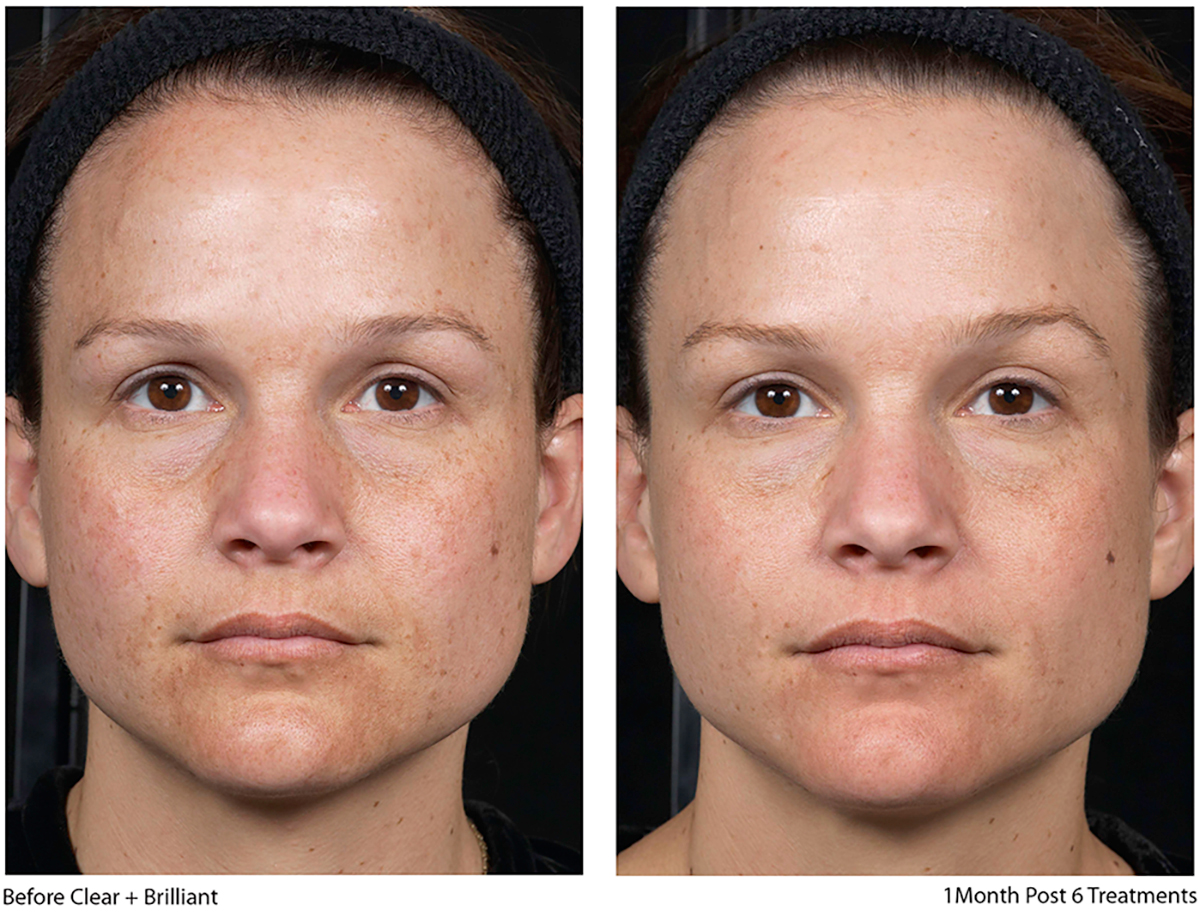 photo of a woman before / after clear + brillant permea laser treatment in Montreal