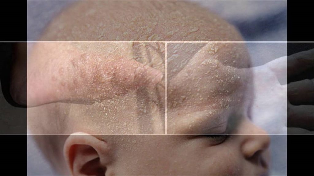 Eczema tổ đỉa ở trẻ nhỏ