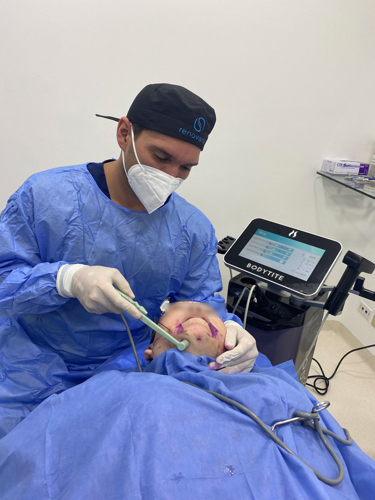 lipopapada radiofrecuencia