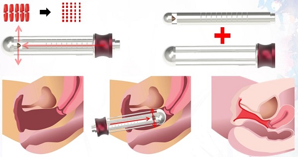 Thẩm mỹ vùng kín hết bao nhiêu tiền