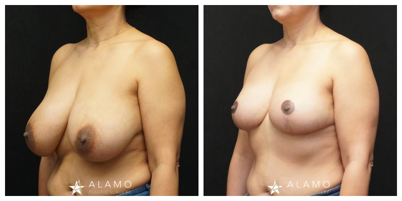 4-month breast lift result – patient after mastopexy without implants, side view
