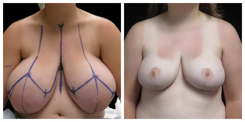 Breast lift patient before and after – natural mastopexy result without implants, front view