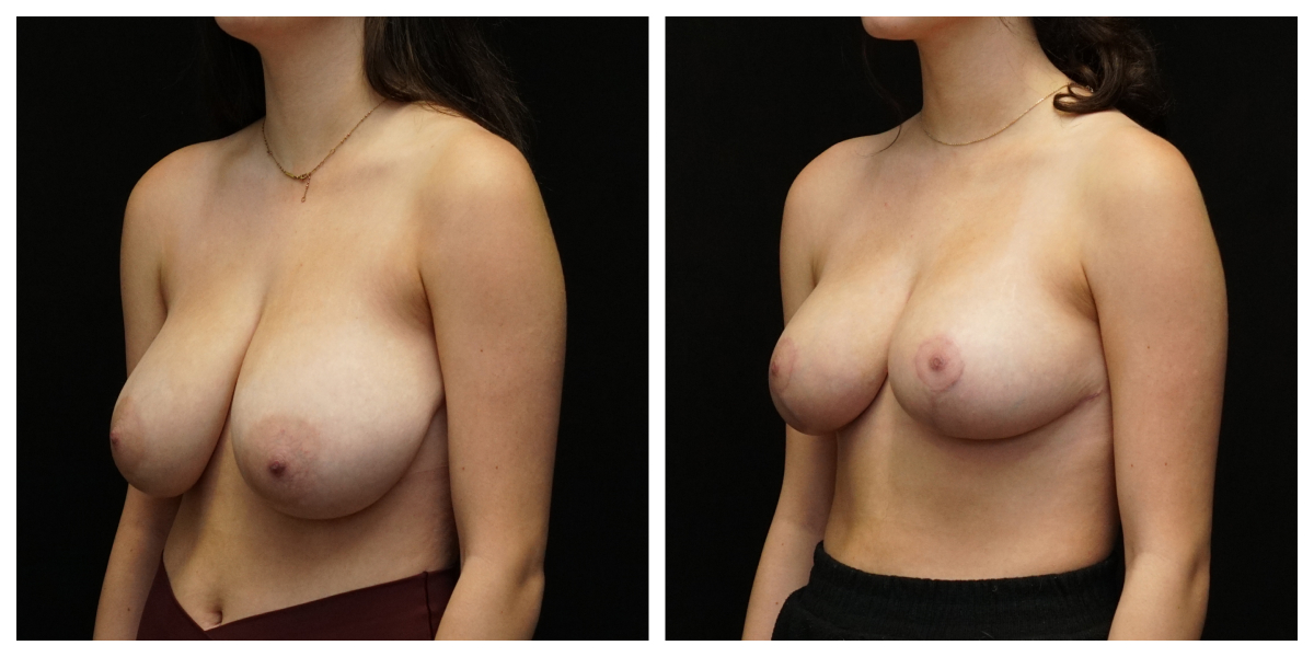 4-month breast lift result – patient after mastopexy without implants, side view