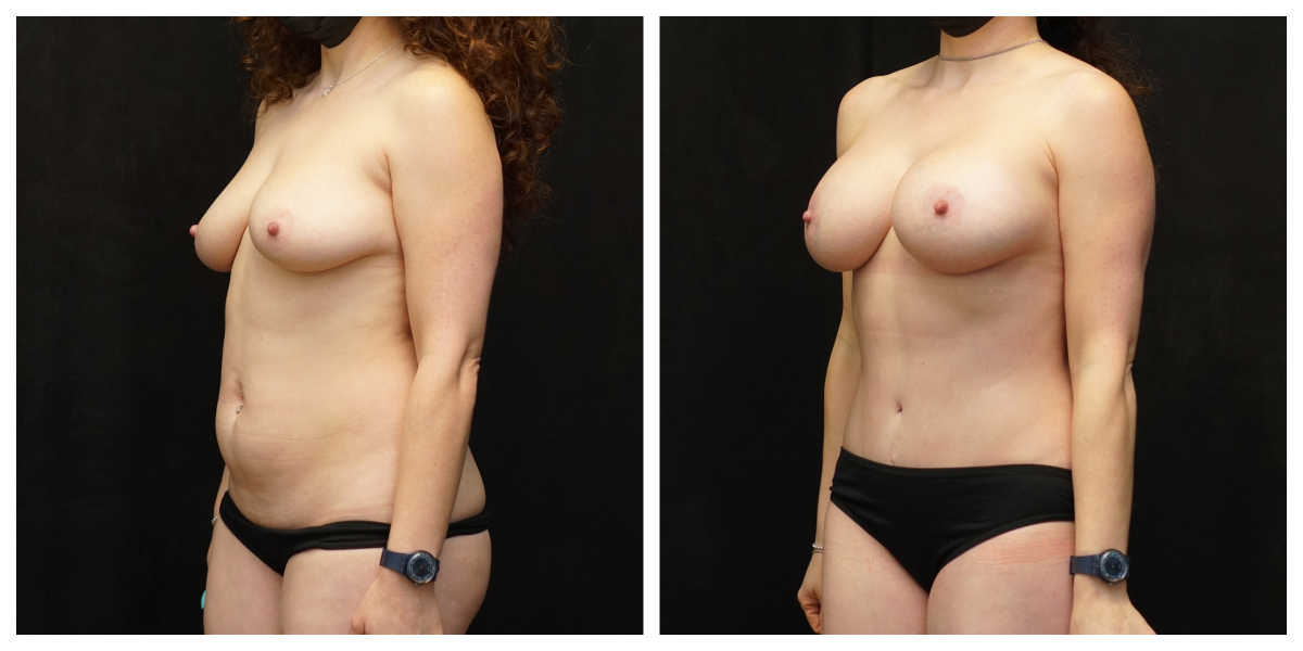 3-month mommy makeover result – 385cc breast augmentation, tummy tuck and liposuction, oblique view