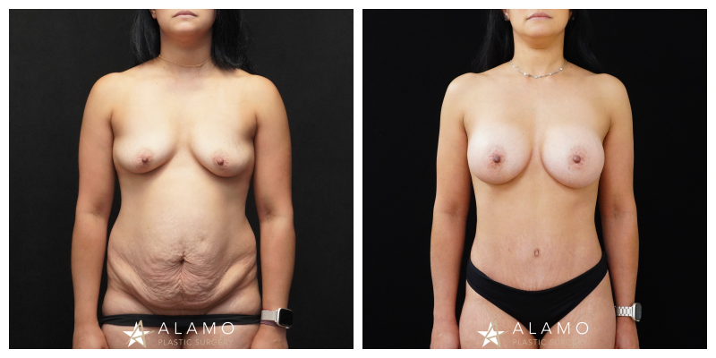 Mommy makeover patient before and after – 345cc breast augmentation and tummy tuck, front view