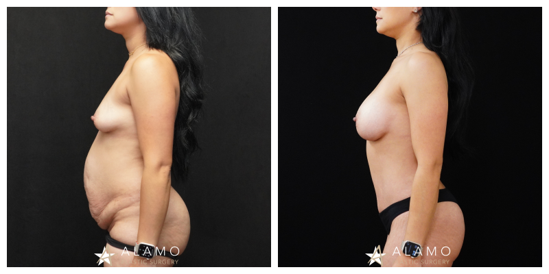 Mommy makeover result – 345cc breast implants with abdominoplasty, oblique view