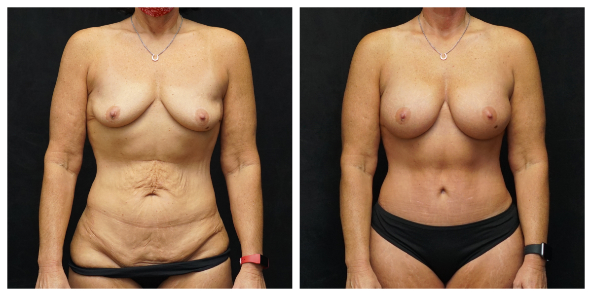 Mommy makeover patient before and after – 360cc SoftTouch breast augmentation and tummy tuck, front view
