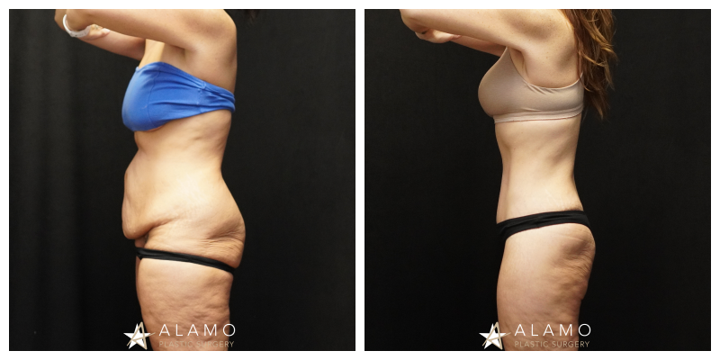 5-month tummy tuck result – patient after abdominoplasty with muscle repair and liposuction, side view