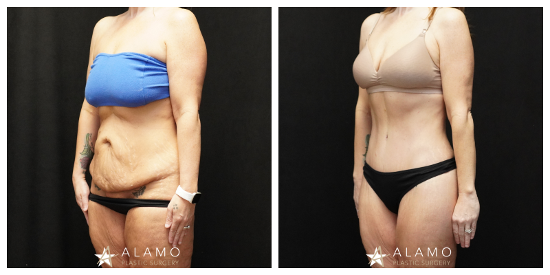 Tummy tuck patient before and after – abdominoplasty with muscle repair and liposuction, oblique view