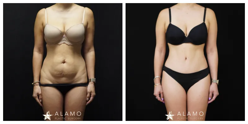 Tummy tuck patient before and after – abdominoplasty with muscle repair and liposuction, front view