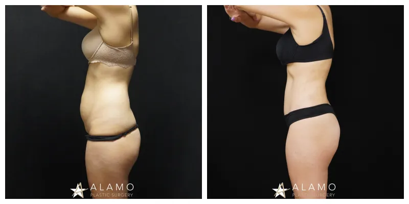 5.5-month tummy tuck result – patient after abdominoplasty with liposuction and hip contouring, oblique view