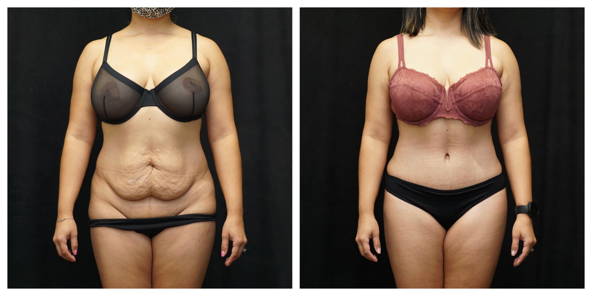 Tummy tuck patient before and after – full abdominoplasty with muscle repair and liposuction, front view