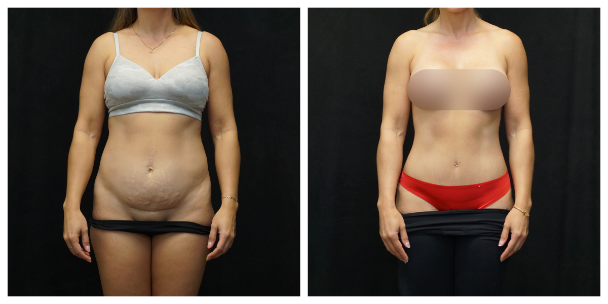 Tummy tuck before and after – full abdominoplasty with muscle repair and liposuction, front view