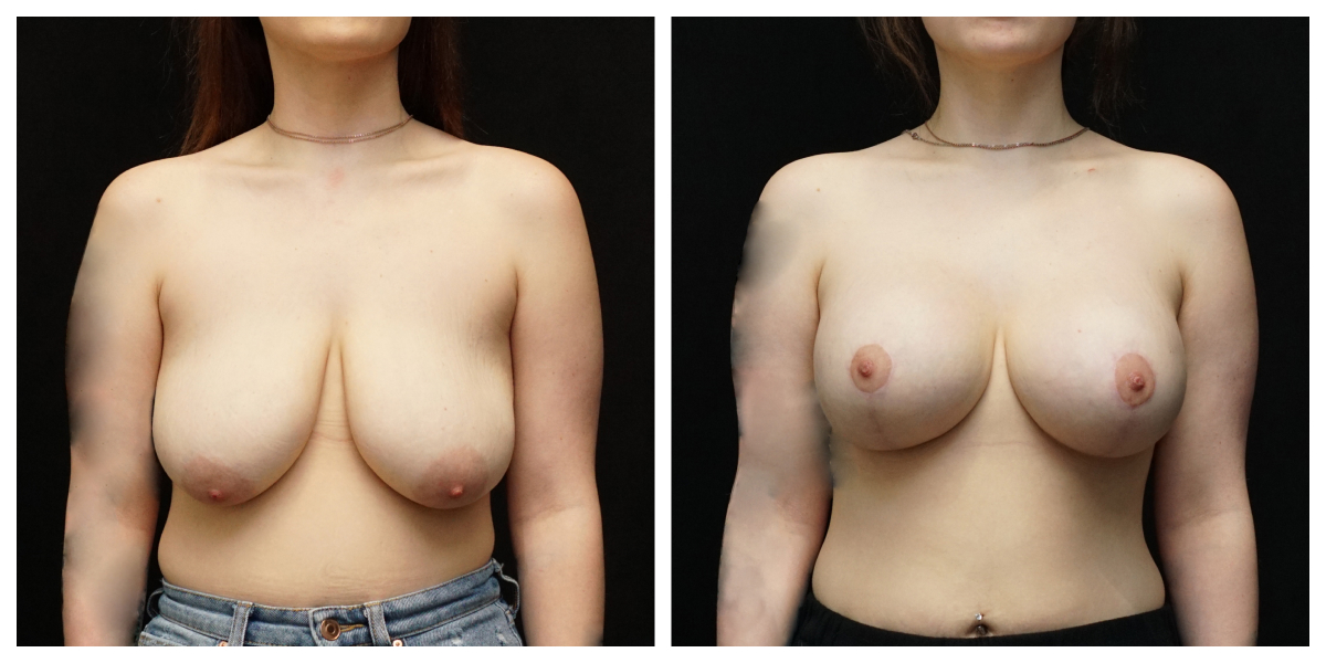 Breast augmentation with lift before and after – 445cc Natrelle SoftTouch silicone implants, front view.