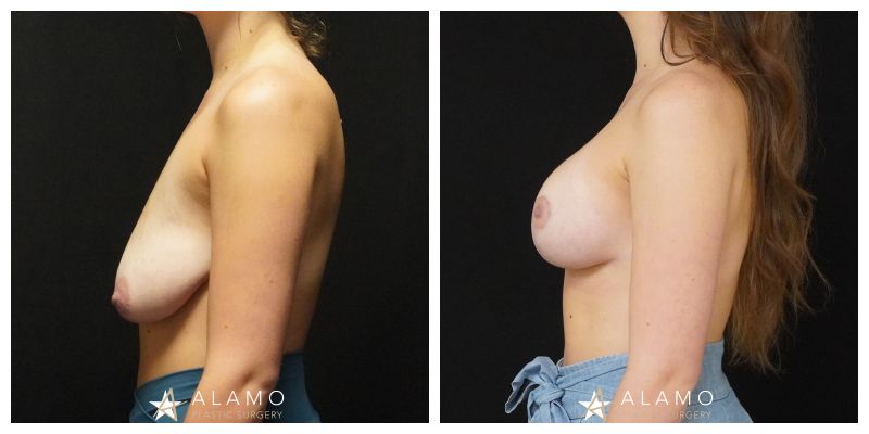 5-month breast augmentation with lift result – 415cc SoftTouch silicone implants, side view.