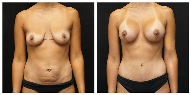 Breast augmentation with lift before and after – 415cc SoftTouch silicone implants, front view.