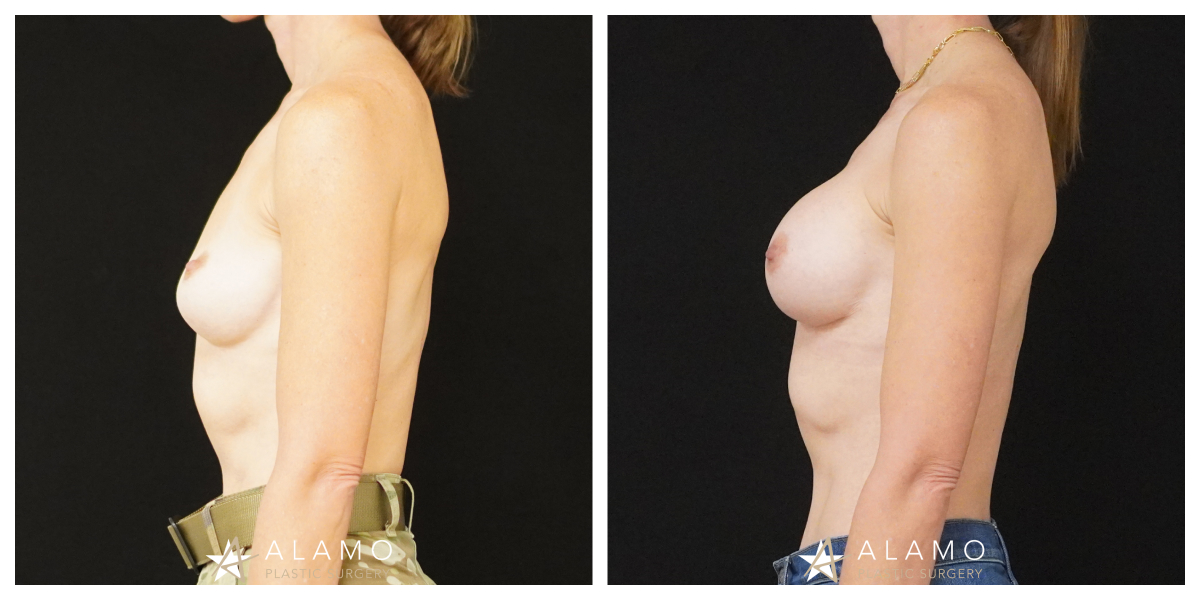 4.5-month breast implant revision result – patient with 365cc SoftTouch silicone implants, oblique view