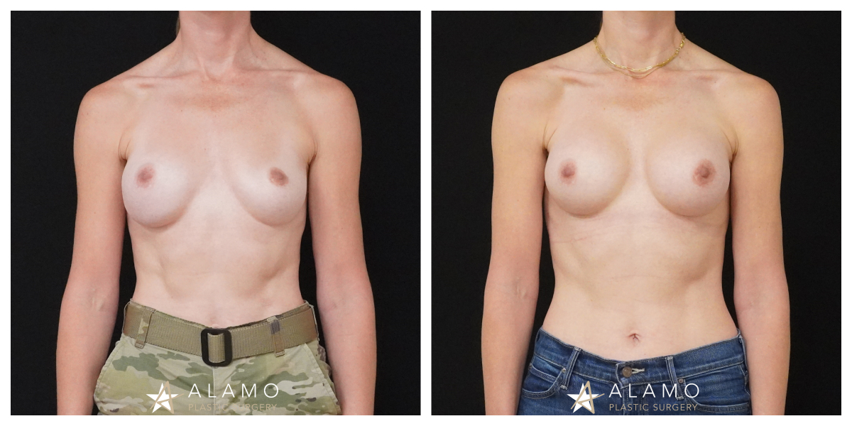 Breast implant revision patient before and after – 365cc SoftTouch silicone implants, front view