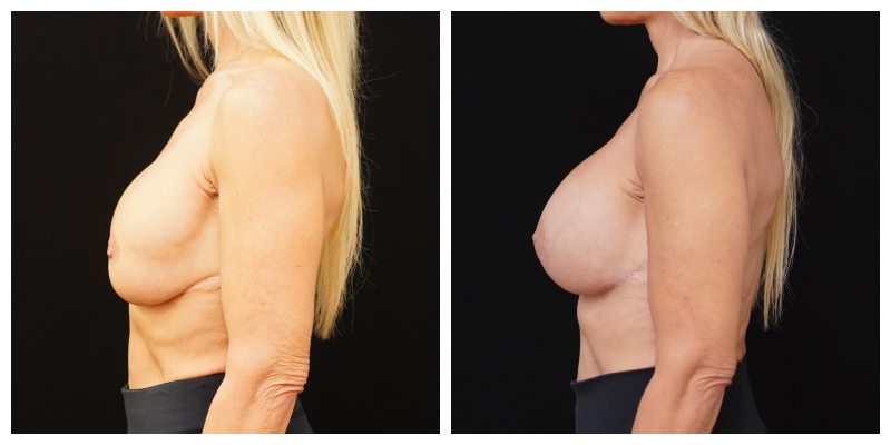 6-month breast implant revision result – patient with 385cc implants and internal breast support, side view