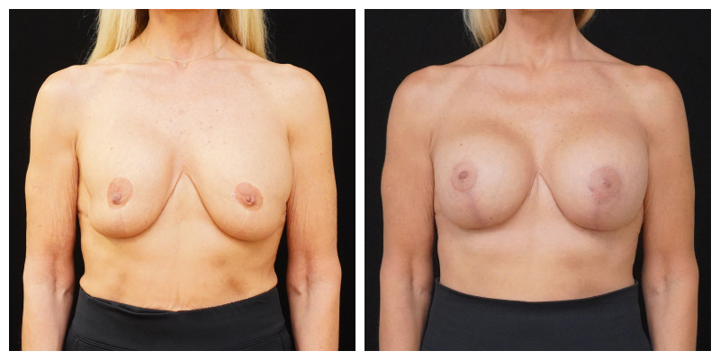 Breast implant revision patient before and after – 385cc implants with internal breast support, front view