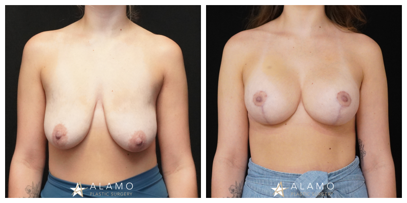 Breast augmentation with lift before and after – 415cc SoftTouch silicone implants, front view.