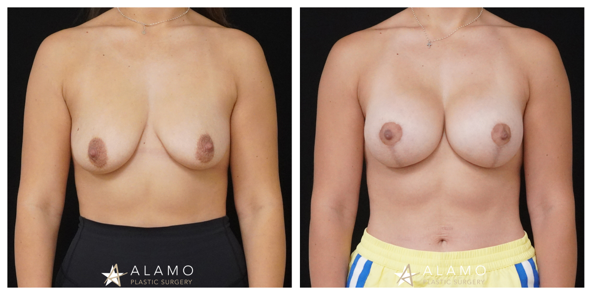 Breast augmentation with lift before and after – 385cc SoftTouch implants, front view.