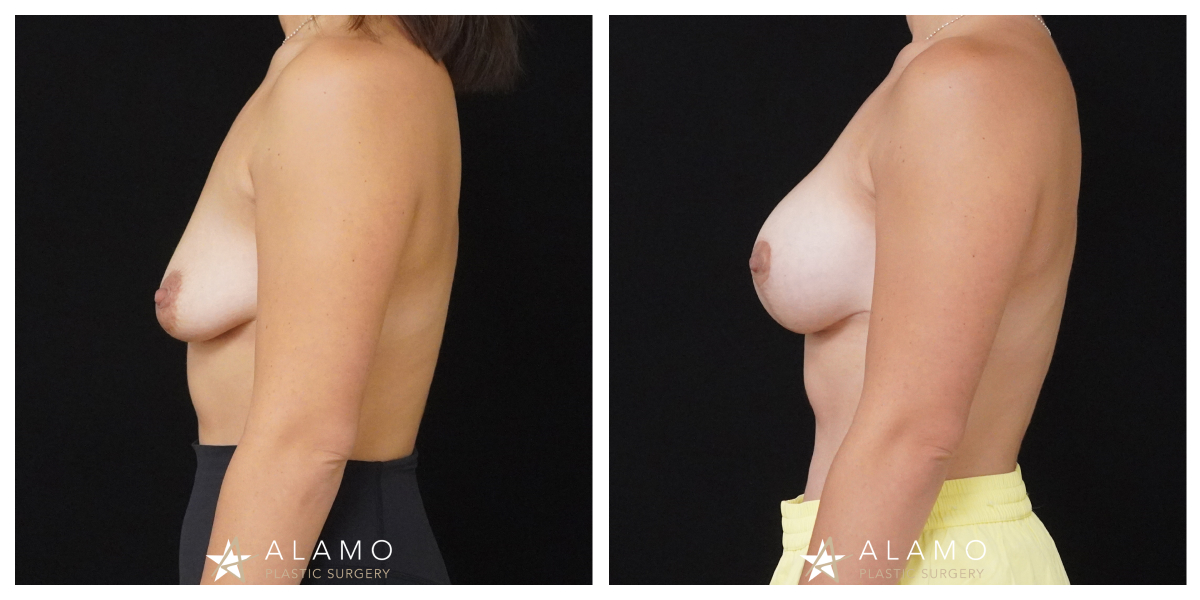 6-month breast augmentation with lift result – 385cc SoftTouch implants, left side view.