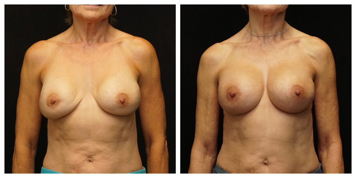 Breast implant revision before and after – 450cc SoftTouch implants with internal breast support, front view.