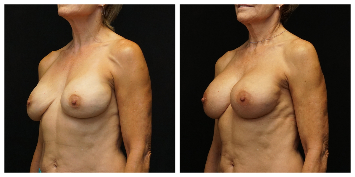 5-month breast implant revision result – 450cc SoftTouch implants with internal breast support, left oblique view.