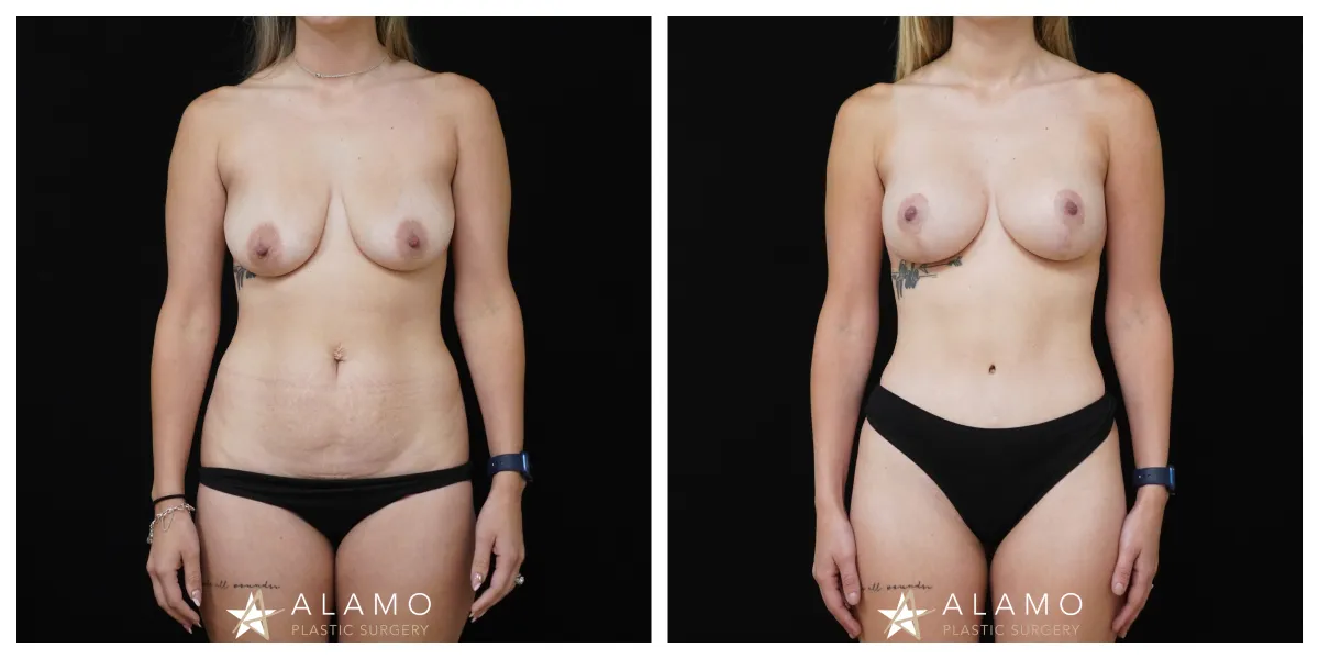 Mommy Makeover before and after – 275cc SoftTouch breast implants with lift and full abdominoplasty with muscle repair, front view.
