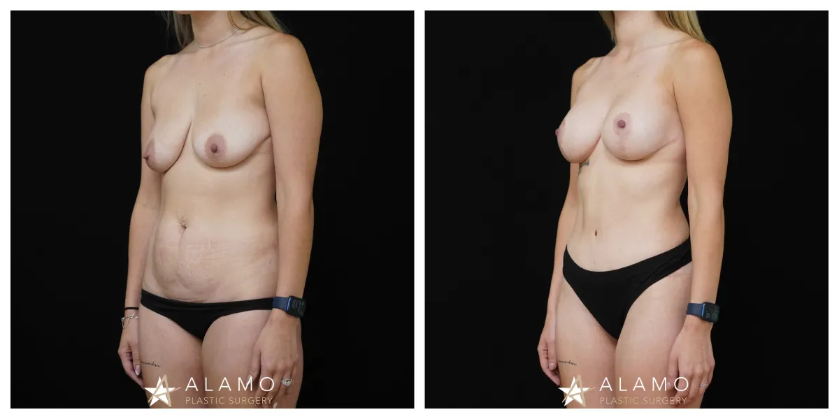 6-month Mommy Makeover result – 275cc SoftTouch breast implants with lift and full abdominoplasty with muscle repair, left oblique view.