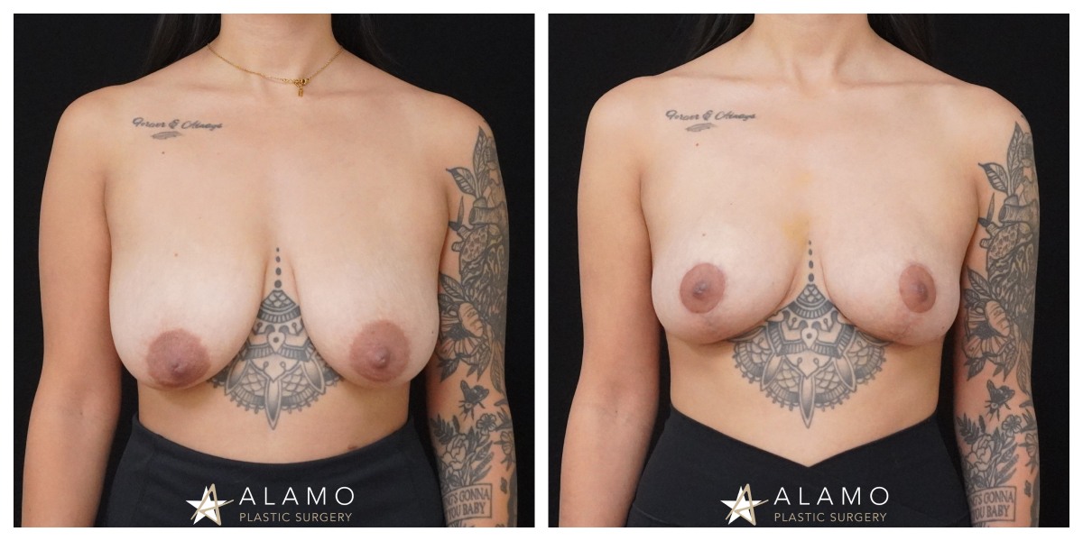 Breast lift before and after – natural breast reshaping without implants, front view.