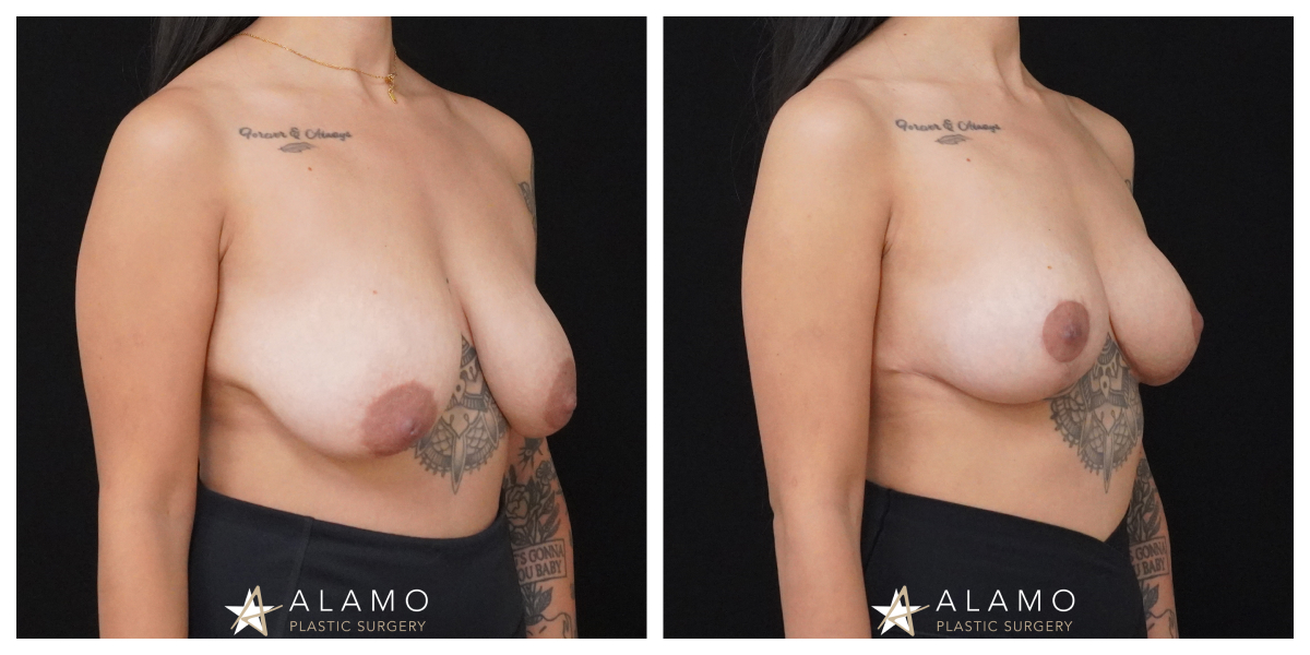 5-month breast lift result – natural breast reshaping without implants, oblique view.
