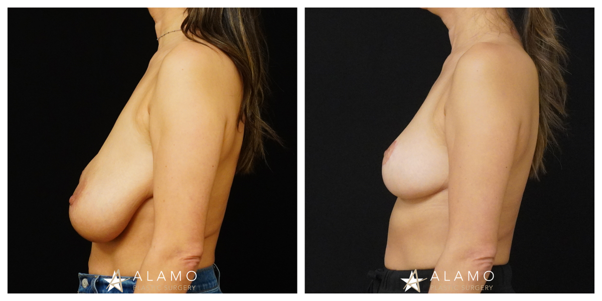 4-month breast lift result – D to C cup size change with improved breast shape, left side view.