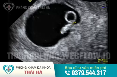 Hình ảnh siêu âm thai 6 tuần tuổi