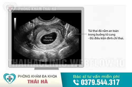 Hình ảnh siêu âm túi thai đã vào tử cung an toàn