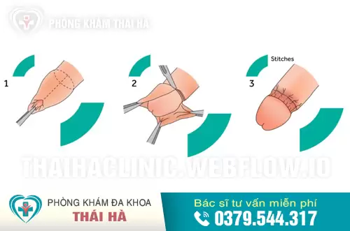 Quy trình cắt bao quy đầu bằng máy Surkon không đau