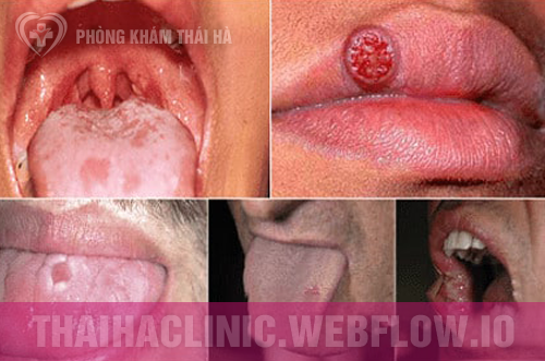 Hình ảnh săng giang mai ở miệng lưỡi