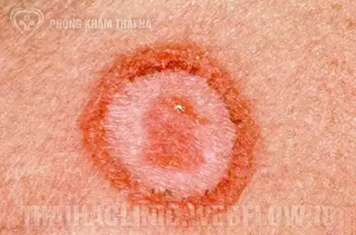 Hình ảnh săng giang mai giai đoạn 1