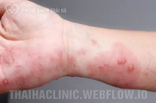 Hình ảnh phát ban giang mai ở tay