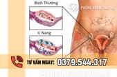 U nang buồng trứng có nguy hiểm không? 3 Biến chứng cần mổ gấp