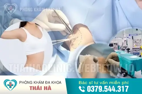Kỹ thuật xâm lấn tối thiểu 360 độ chữa hôi nách an toàn - hiệu quả
