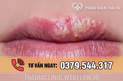 Hình ảnh mụn rộp sinh dục ở môi - miệng
