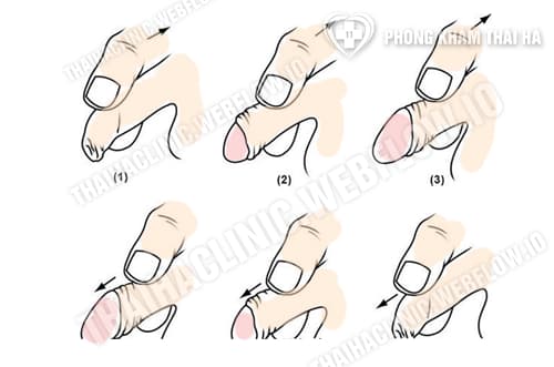 Hướng dẫn cách lột bao quy đầu tại nhà an toàn đúng cách