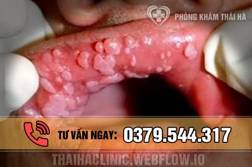 Hình ảnh bệnh sùi mào gà ở môi 1
