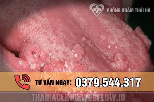 Hình ảnh bệnh sùi mào gà ở lưỡi 3