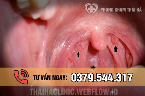 Hình ảnh bệnh sùi mào gà ở vòng họng 2