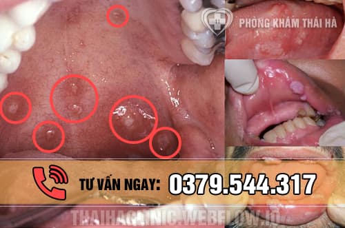 Bệnh sùi mào gà ở miệng